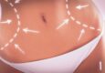 Mini Abdominoplasty Procedure